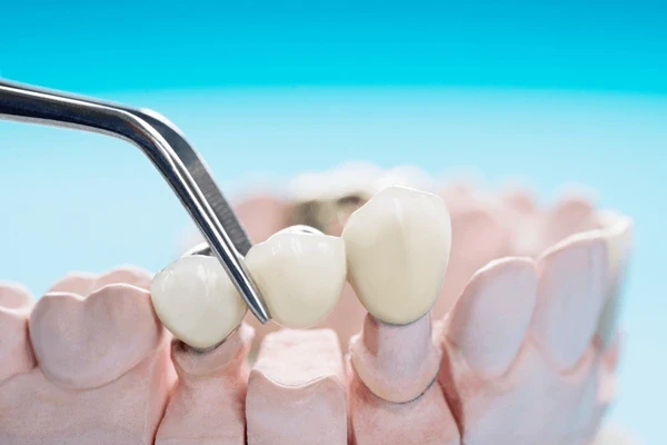dental bridges in london on