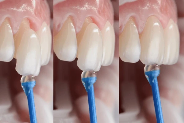 dental veneers in north london, on